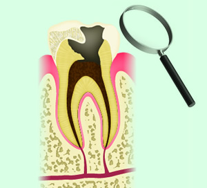 虫歯診断