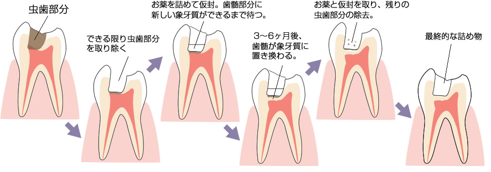 歯髄温存療法