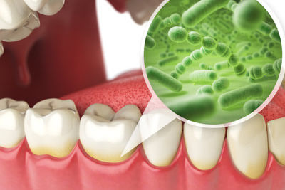 歯周病常在菌