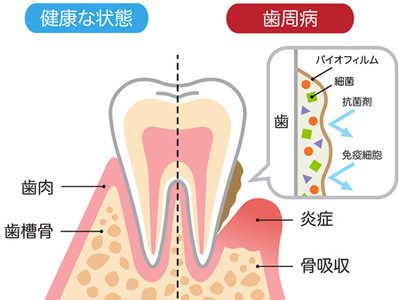 歯周病が全身に及ぼす影響と病気